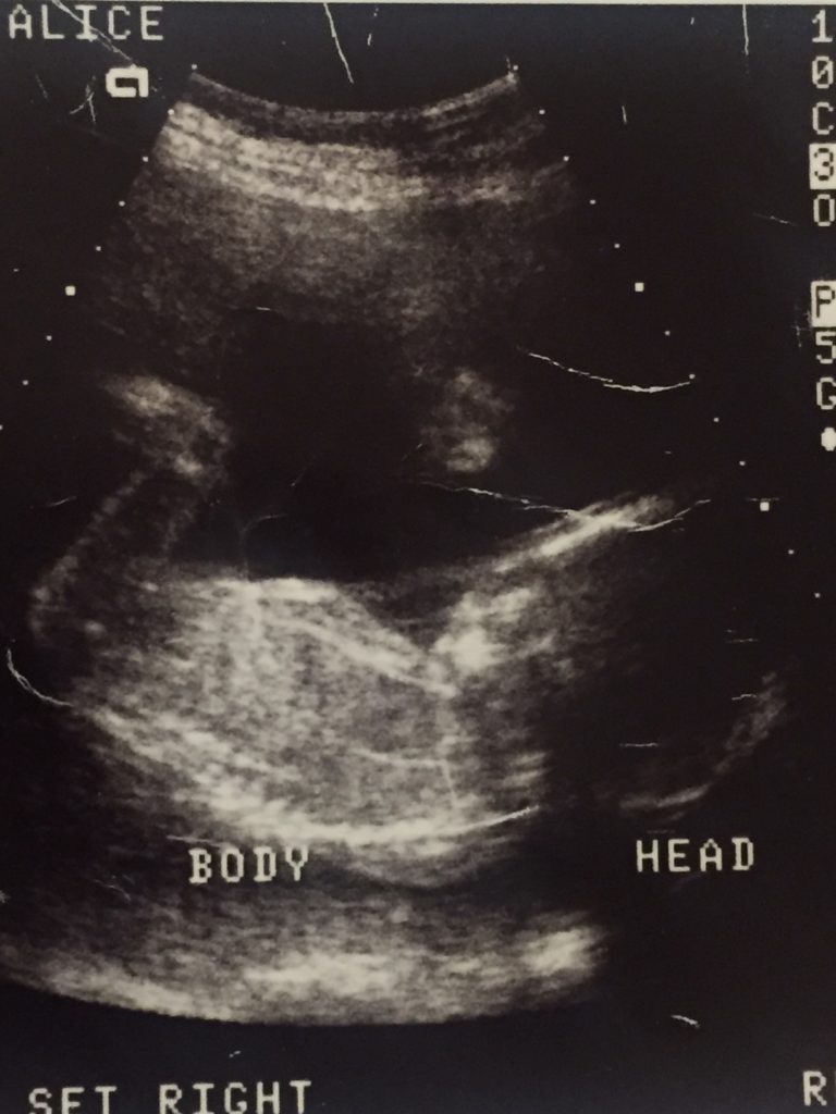 ultrasound picture of a baby